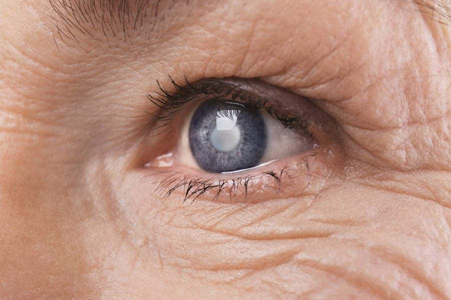 comment eviter l operation de la cataracte chirurgie cataracte paris dr romain nicolau