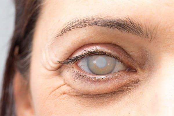 cataracte risques effets secondaires ophtalmo paris specialiste chirurgie refractive chirurgie cataracte paris docteur romain nicolau