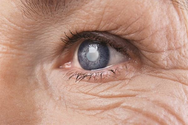 cataracte symptomes definition ophtalmo paris specialiste chirurgie refractive chirurgie cataracte paris docteur romain nicolau