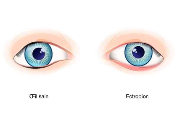 ectropion symptomes definition traitement ophtalmo paris specialiste chirurgie refractive chirurgie cataracte paris dr romain nicolau