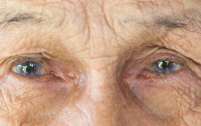Pourquoi opérer les 2 yeux de la cataracte ?