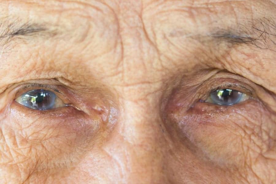 pourquoi operer les 2 yeux de la cataracte dr romain nicolau ophtalmologue specialiste chirurgie cataracte paris