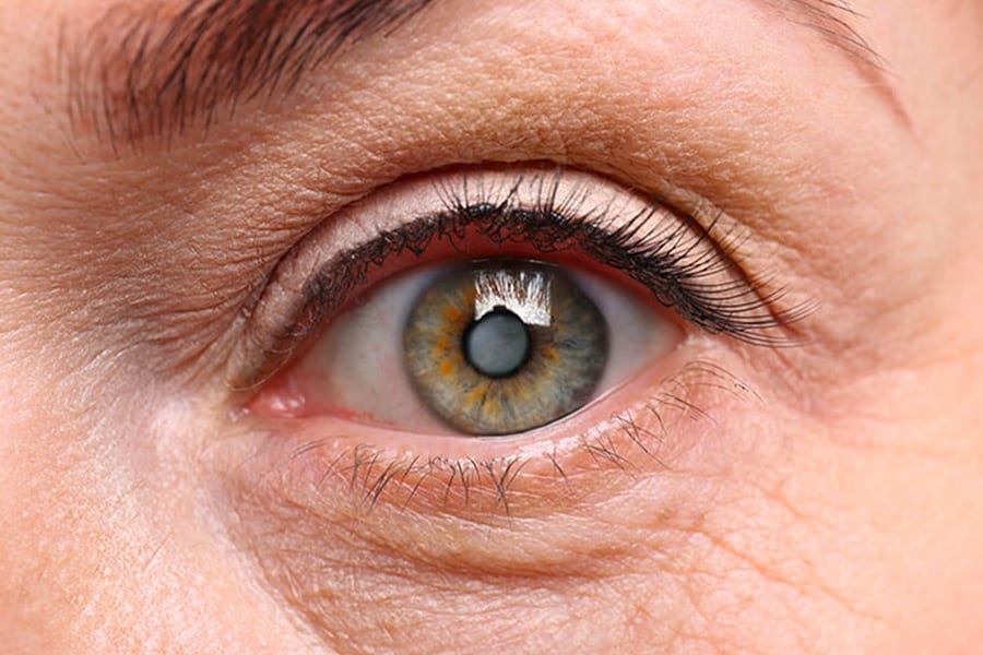 implants cataracte monofocaux avantages dr romain nicolau chirurgien ophtalmologue specialiste chirurgie cataracte paris