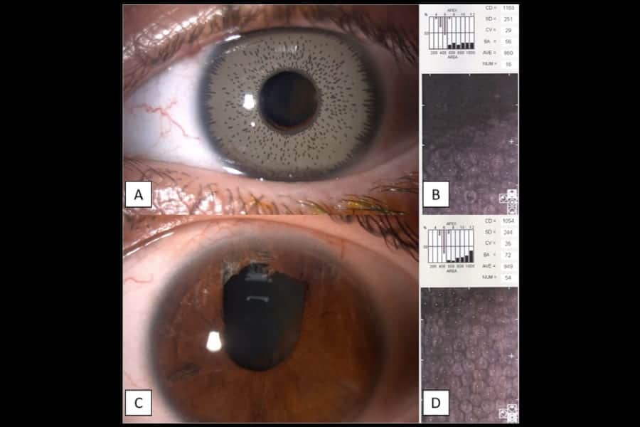 implant esthetique changer couleur yeux operation laser yeux paris dr romain nicolau