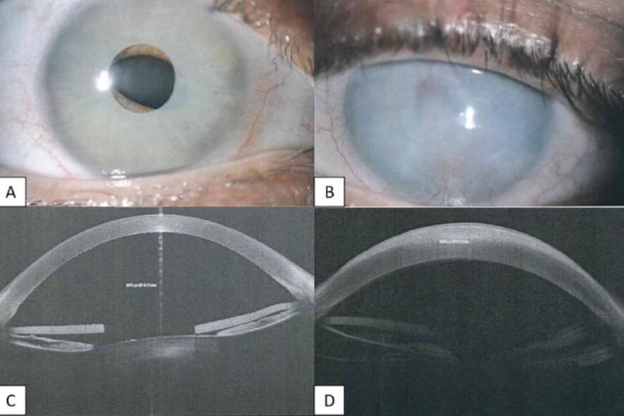 implant iris changer couleur yeux operation laser yeux paris dr romain nicolau