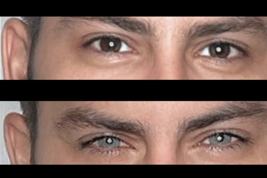 keratopigmentation changer couleur yeux operation laser yeux paris dr romain nicolau