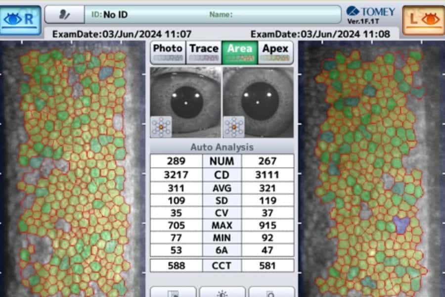 microscopie speculaire deux yeux avant chirurgie paris docteur romain nicolau opthalmologue specialiste chirurgie refractive paris