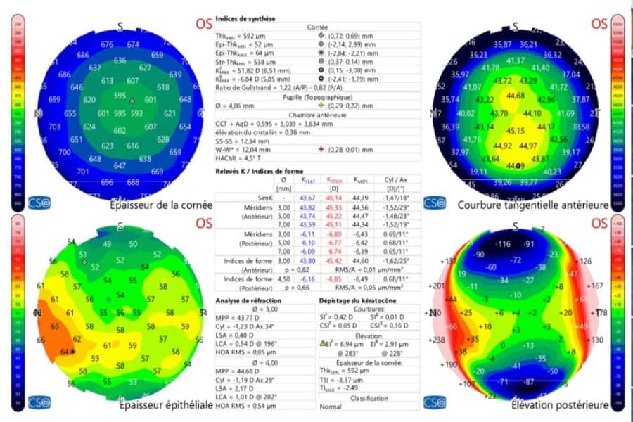 topographie corneenne chirurgie refractive paris docteur romain nicolau opthalmologue specialiste chirurgie refractive paris