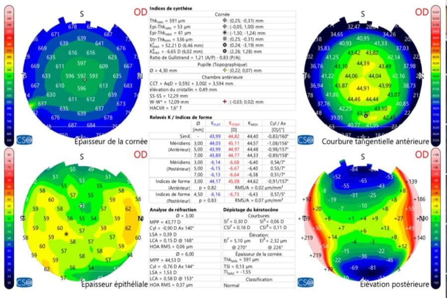 topographie corneenne hirurgie refractive paris dr romain nicolau opthalmologue specialiste chirurgie refractive paris